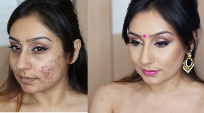 acne makeup tutorial